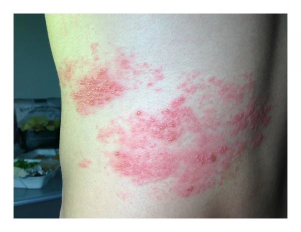 What Are Shingles Caused From, Shingles Symtoms, Shingles Are They Contagious, Shingles Facts
