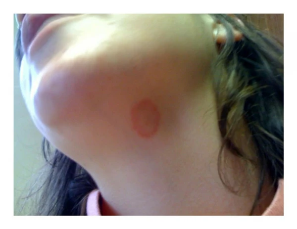 Getting Rid Of Ringworm, How Long Does It Take To Cure Ringworm, Best Way To Get Rid Of Ringworm