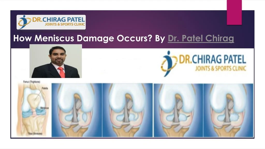 how meniscus damage occurs by dr patel chirag