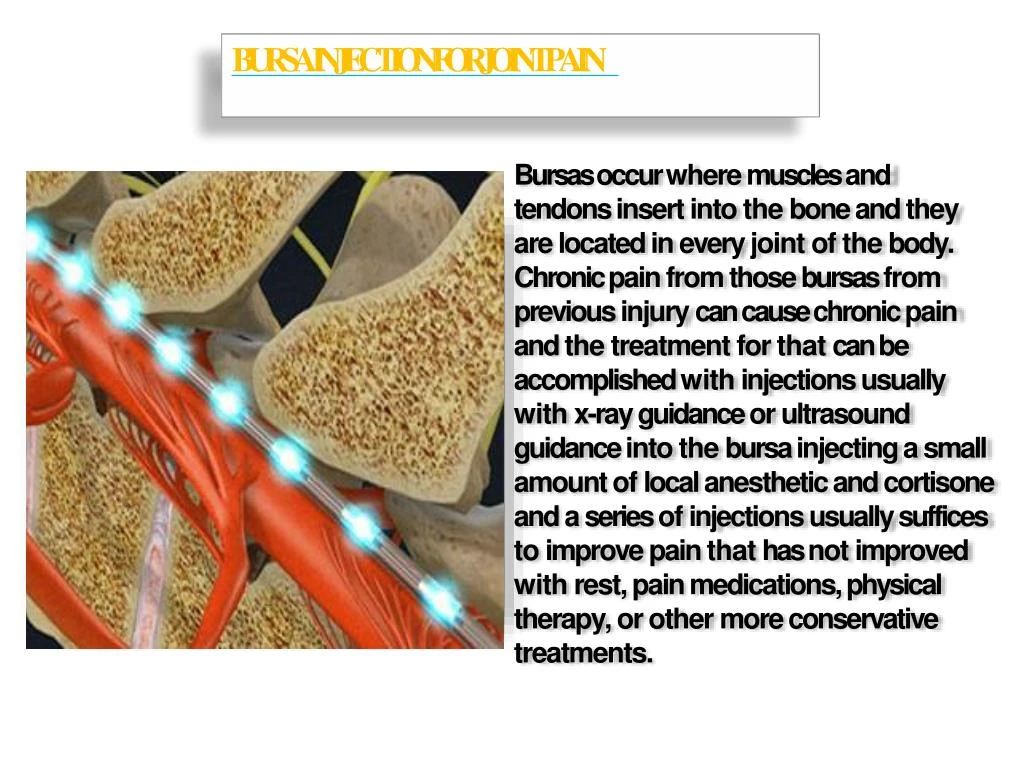 bursa injection for joint pain