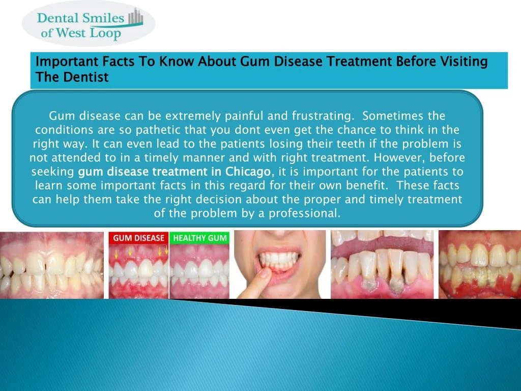 important facts to know about gum disease