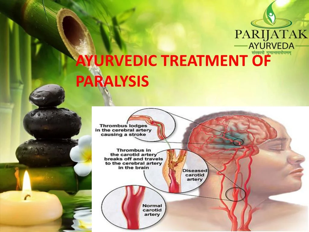 ayurvedic treatment of paralysis