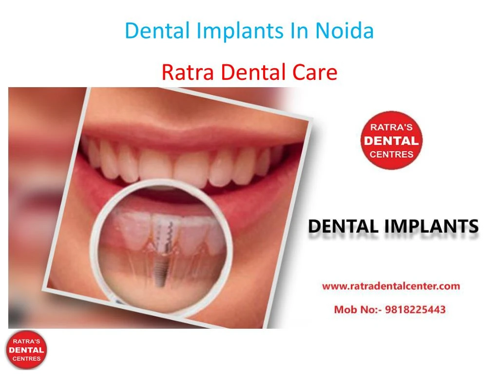 dental implants in noida