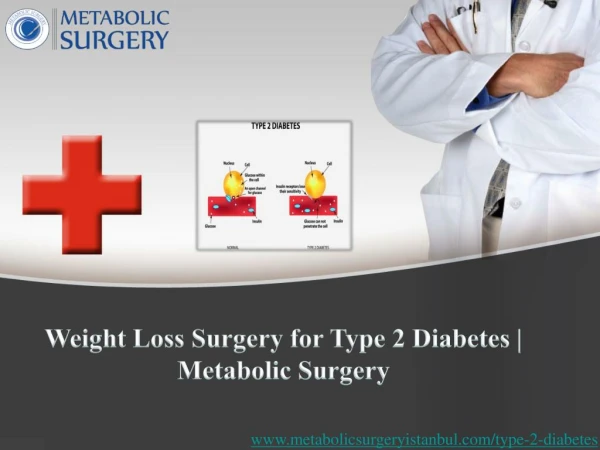 Method of Weight Loss Surgery for Type 2 Diabetes