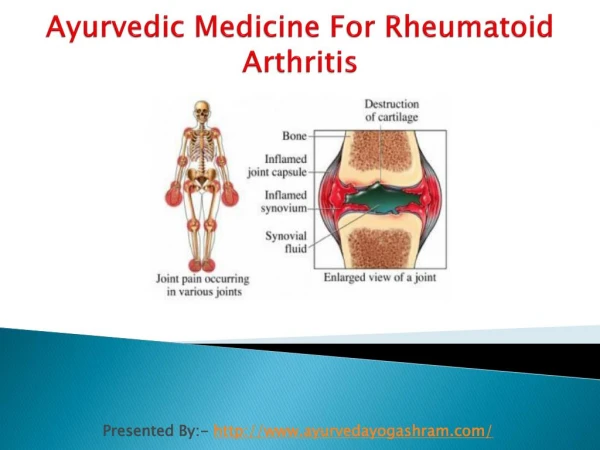 Ayurvedic Medicine For Rheumatoid Arthritis