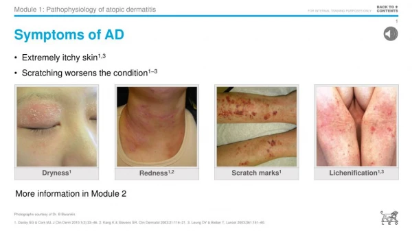 module 1 pathophysiology of atopic dermatitis