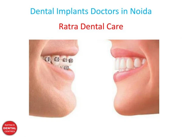 Dental Implants Doctors in Noida