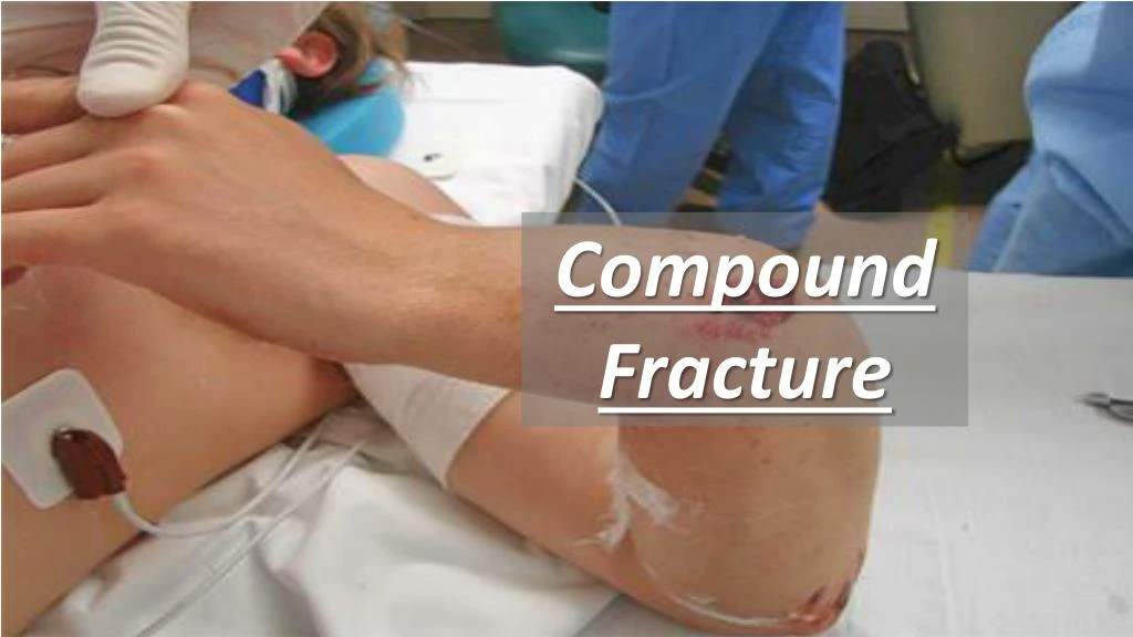 compound fracture