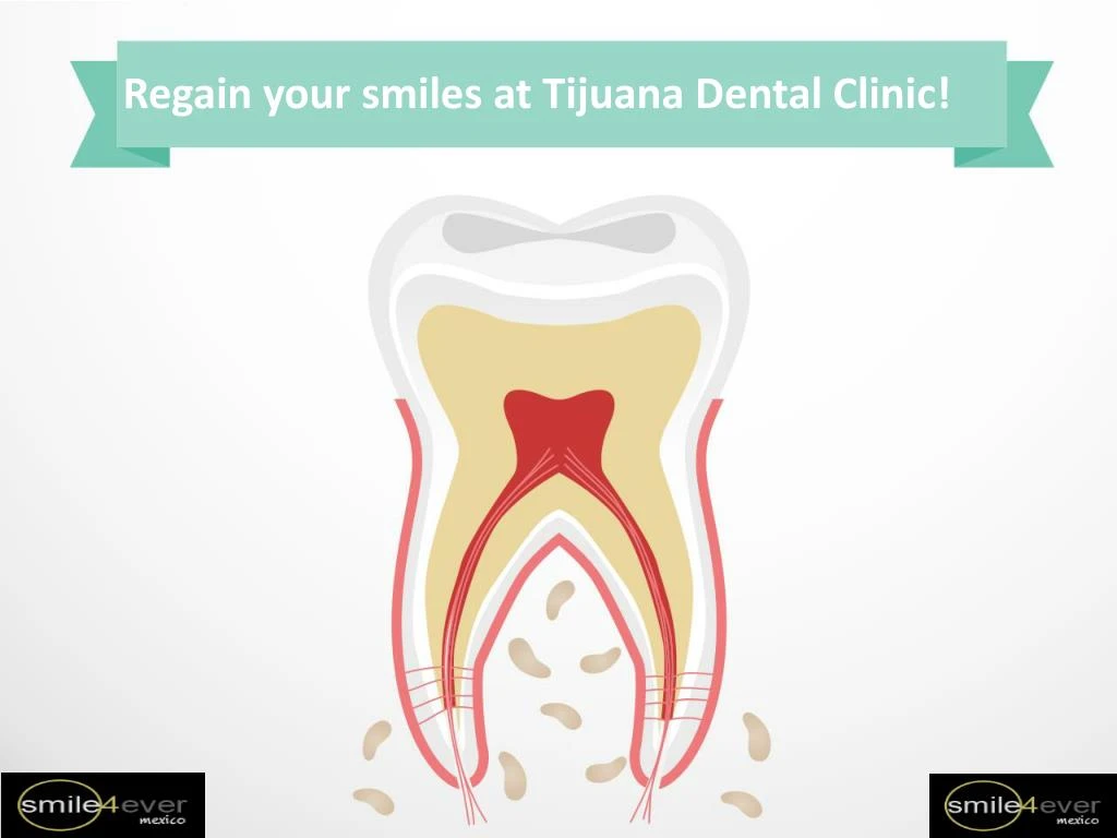 regain your smiles at tijuana dental clinic