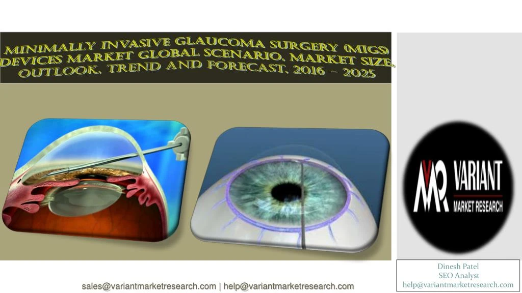 minimally invasive glaucoma surgery migs devices
