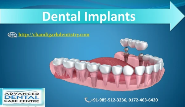 Best Dental implant surgery in chandigarh