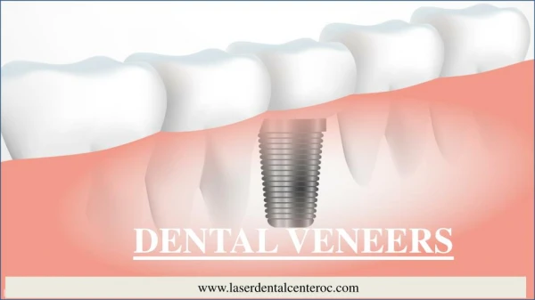 Essential Things To Know About Dental Veneers