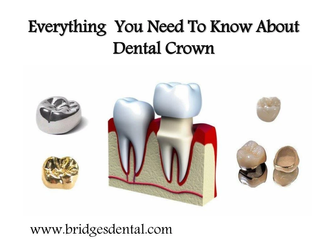 everything you need to know about dental crown