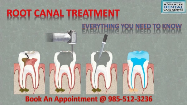 Root Canal Treatment in Tricity