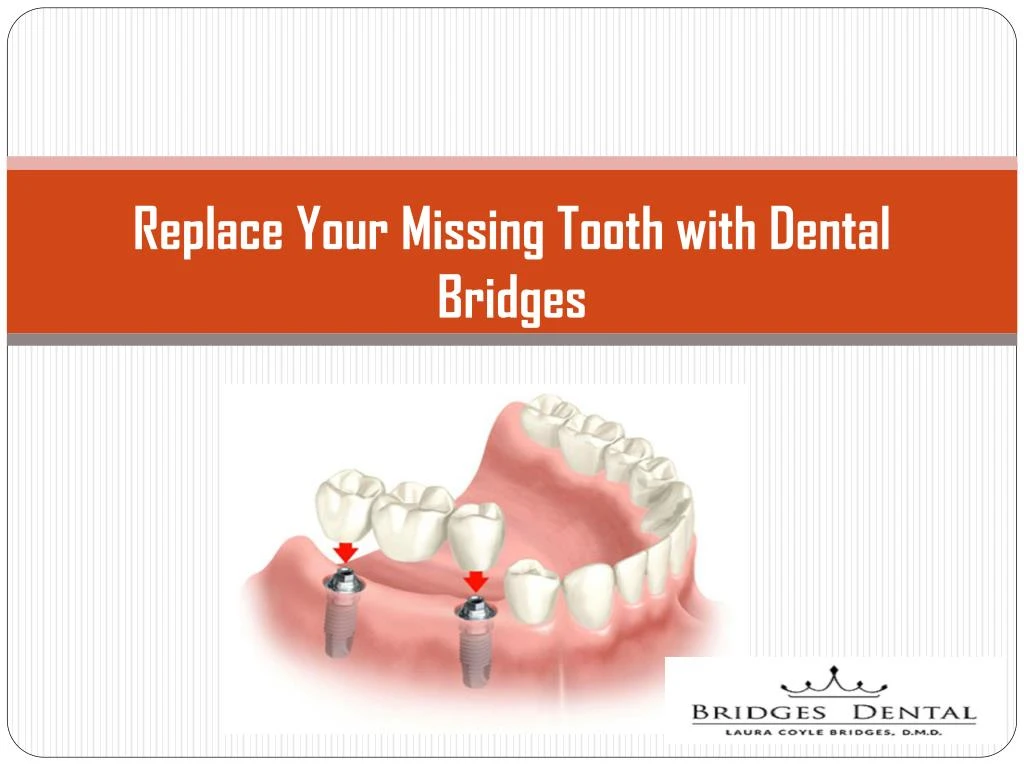 replace your missing tooth with dental bridges