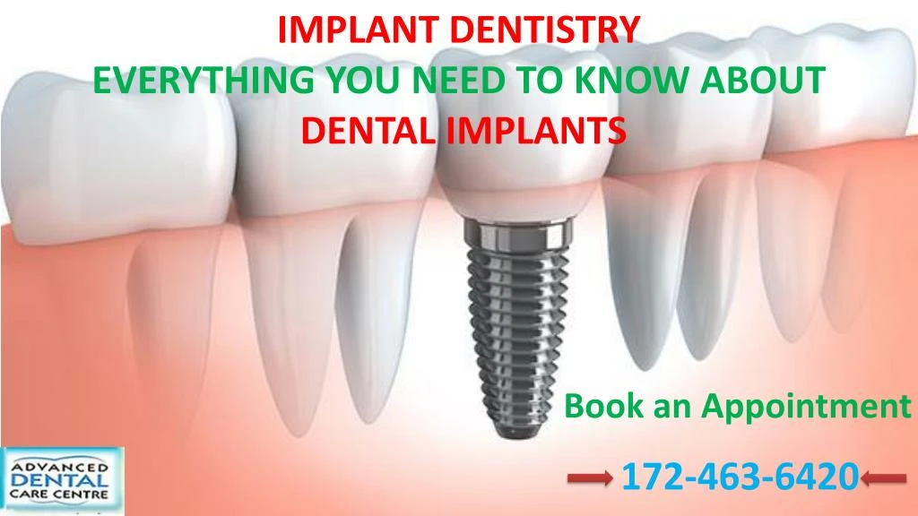 implant dentistry everything you need to know