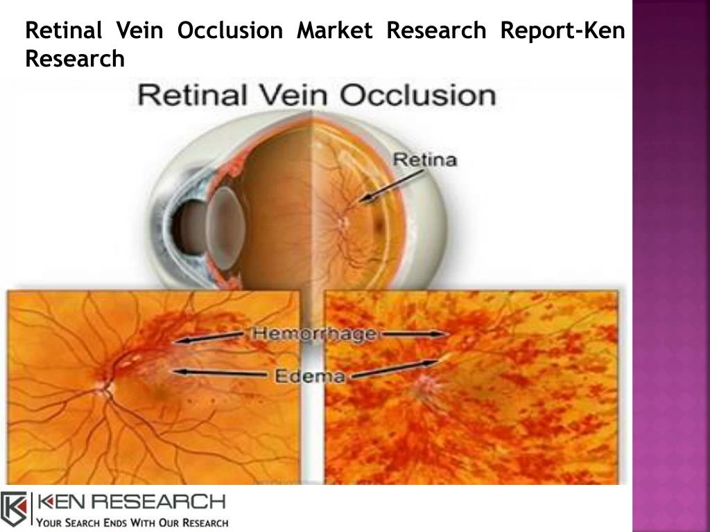 retinal vein occlusion market research report