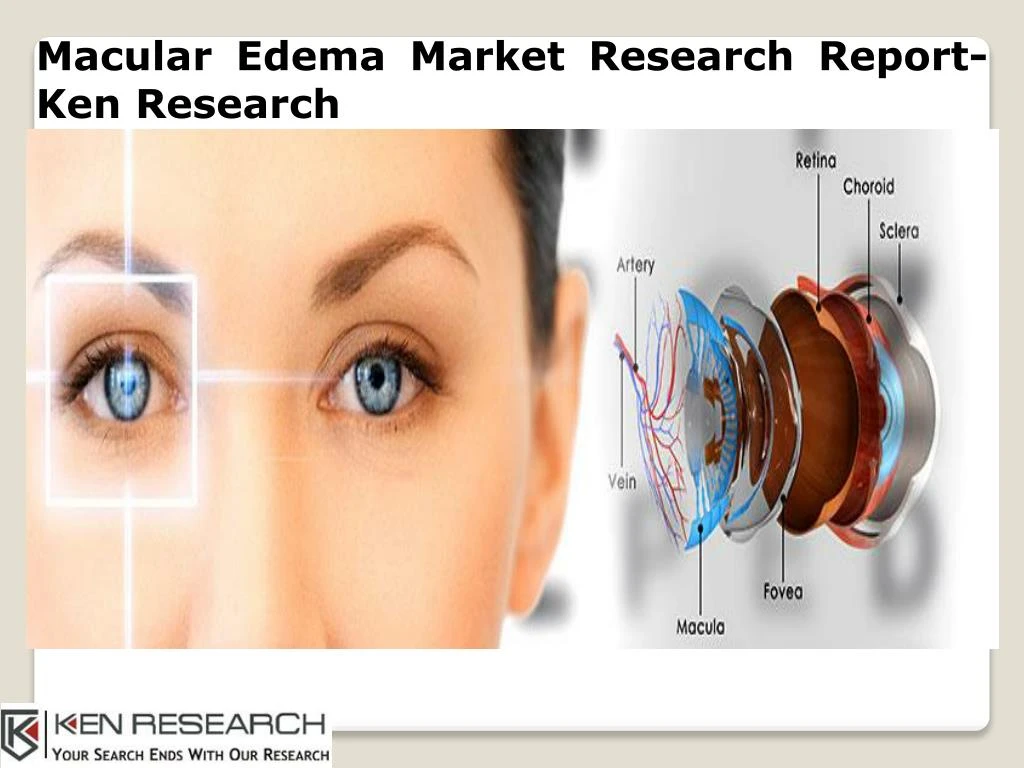macular edema market research report ken research