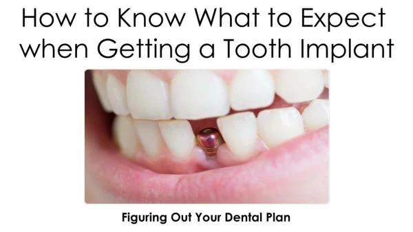 How to Know What to Expect when Getting a Tooth Implant