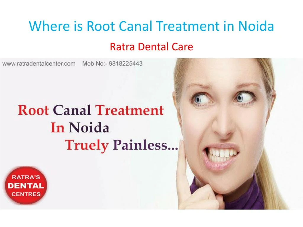 where is root canal treatment in noida
