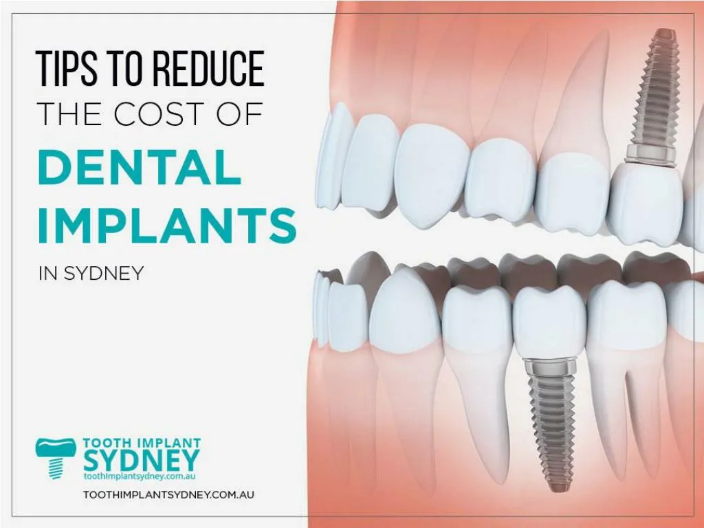 tips to reduce the cost of dental implants in sydney