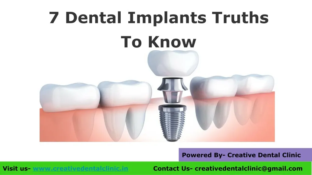 7 dental implants truths to know