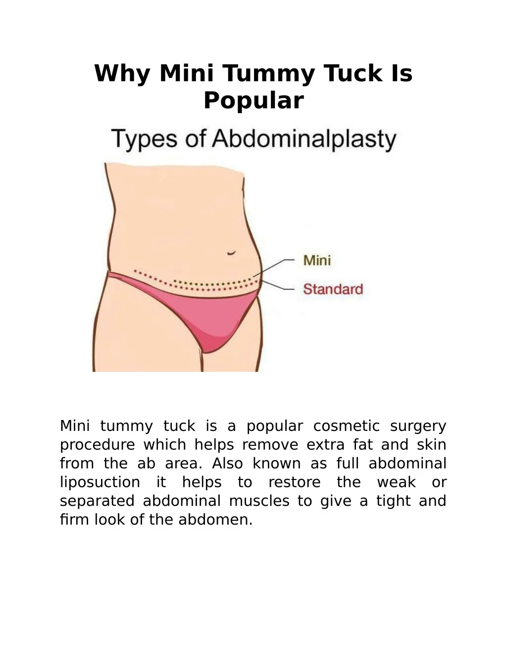 why mini tummy tuck is popular