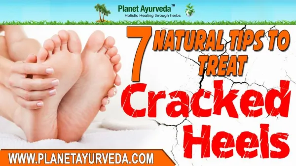 7 Natural Remedies For Cracked Heels