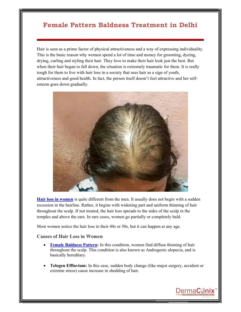 female pattern baldness treatment in delhi