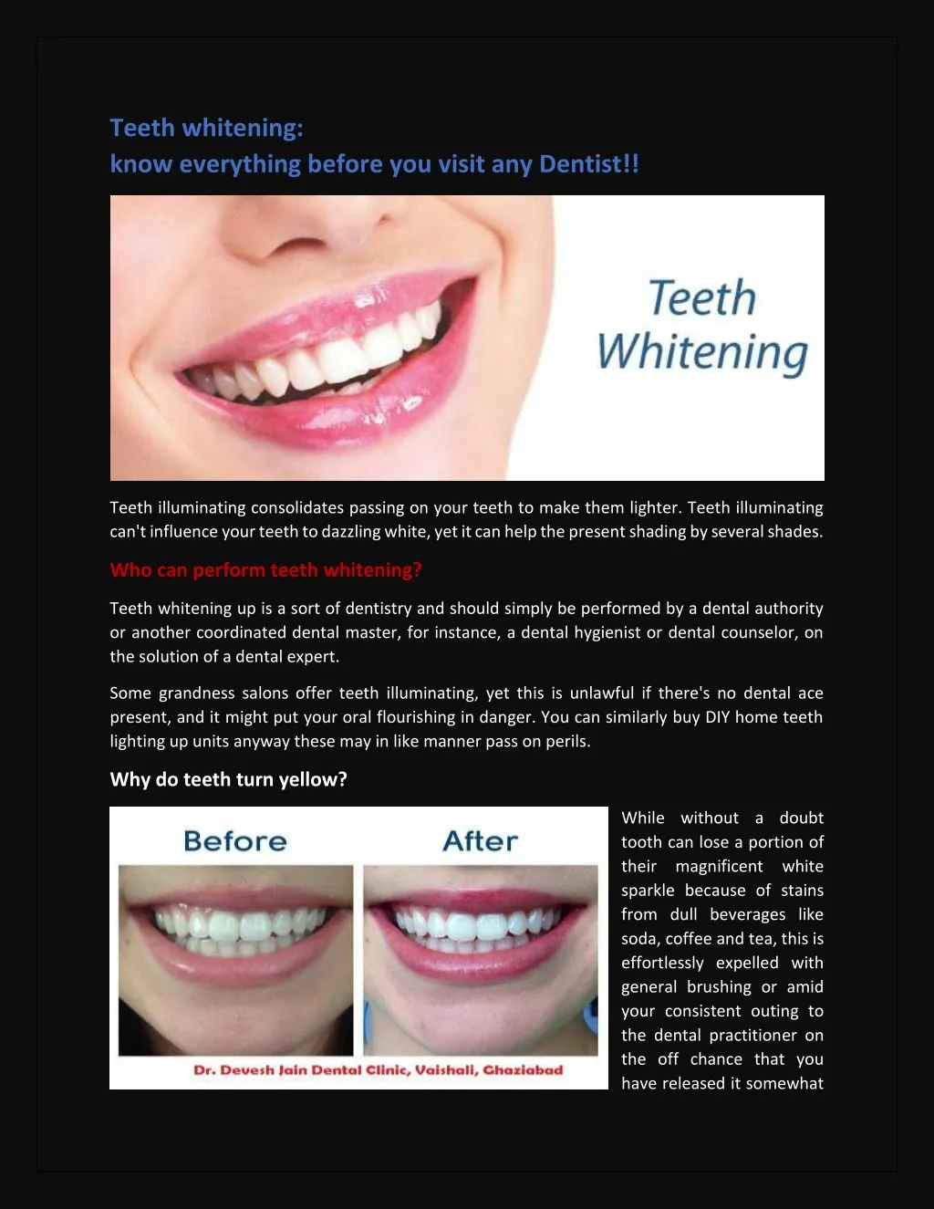 teeth whitening know everything before you visit