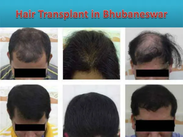 hair transplant in bhubaneswar