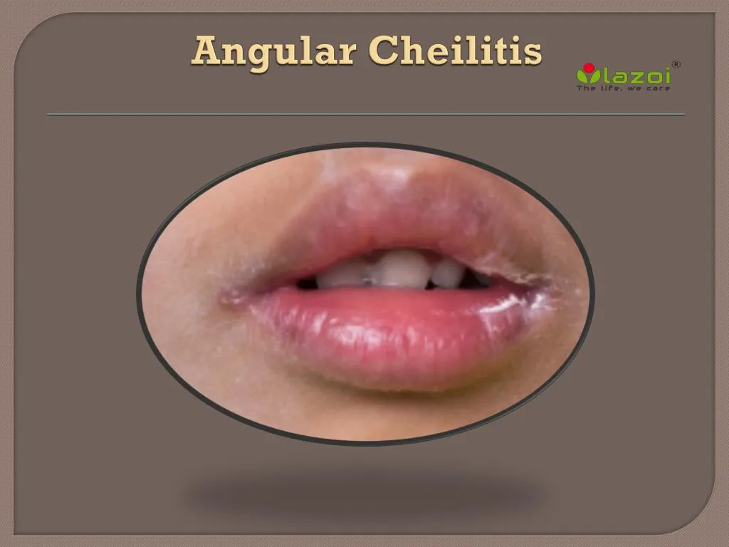 angular cheilitis