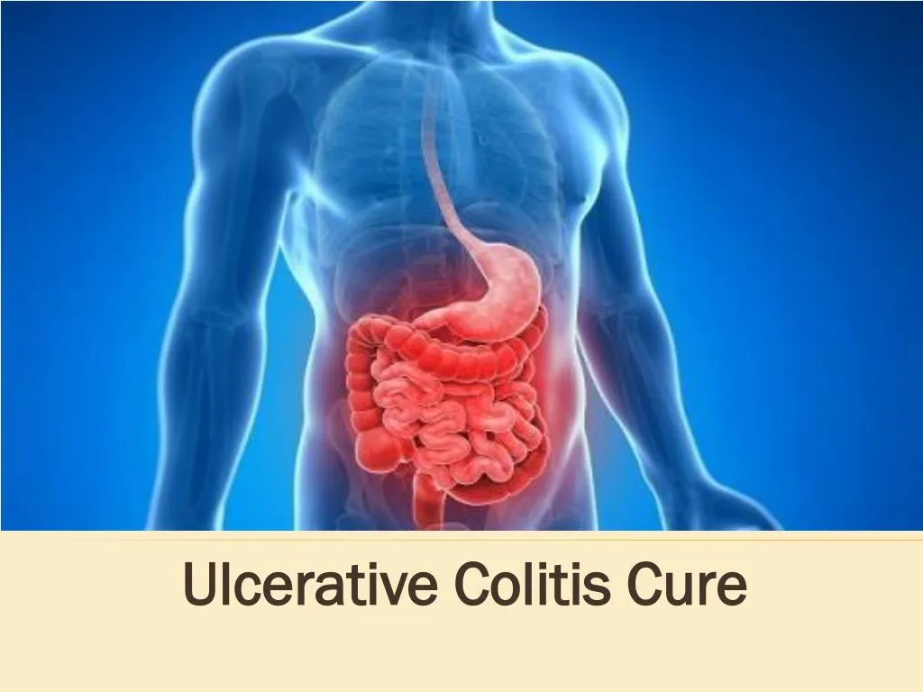 ulcerative colitis cure
