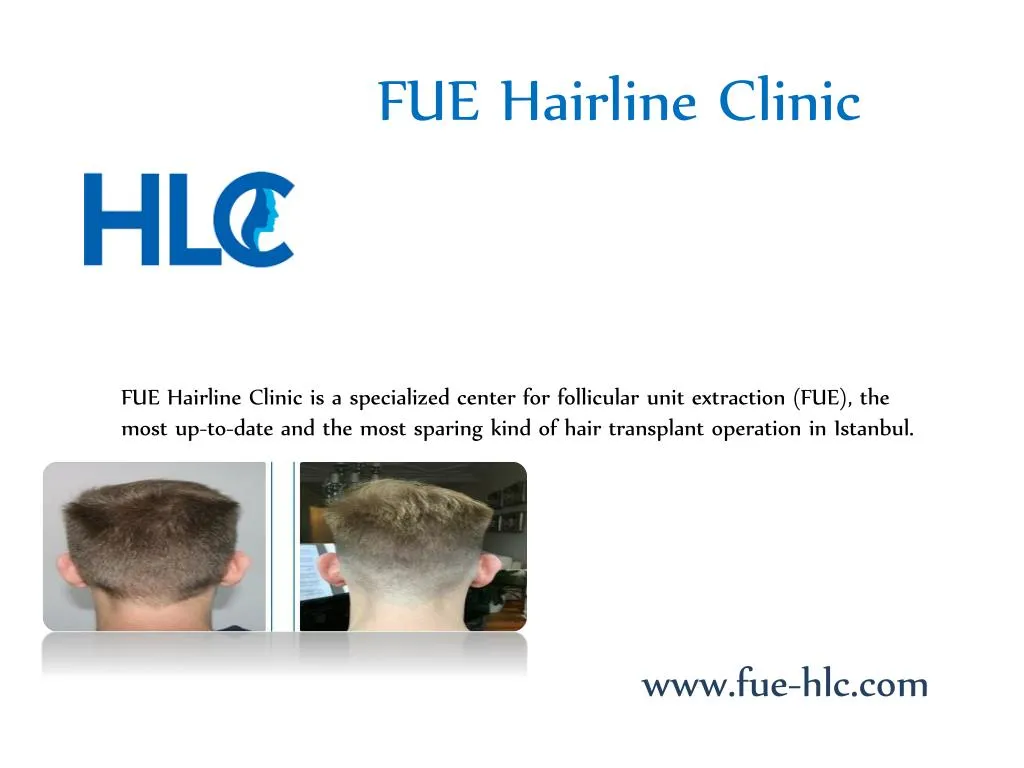 fue hairline clinic