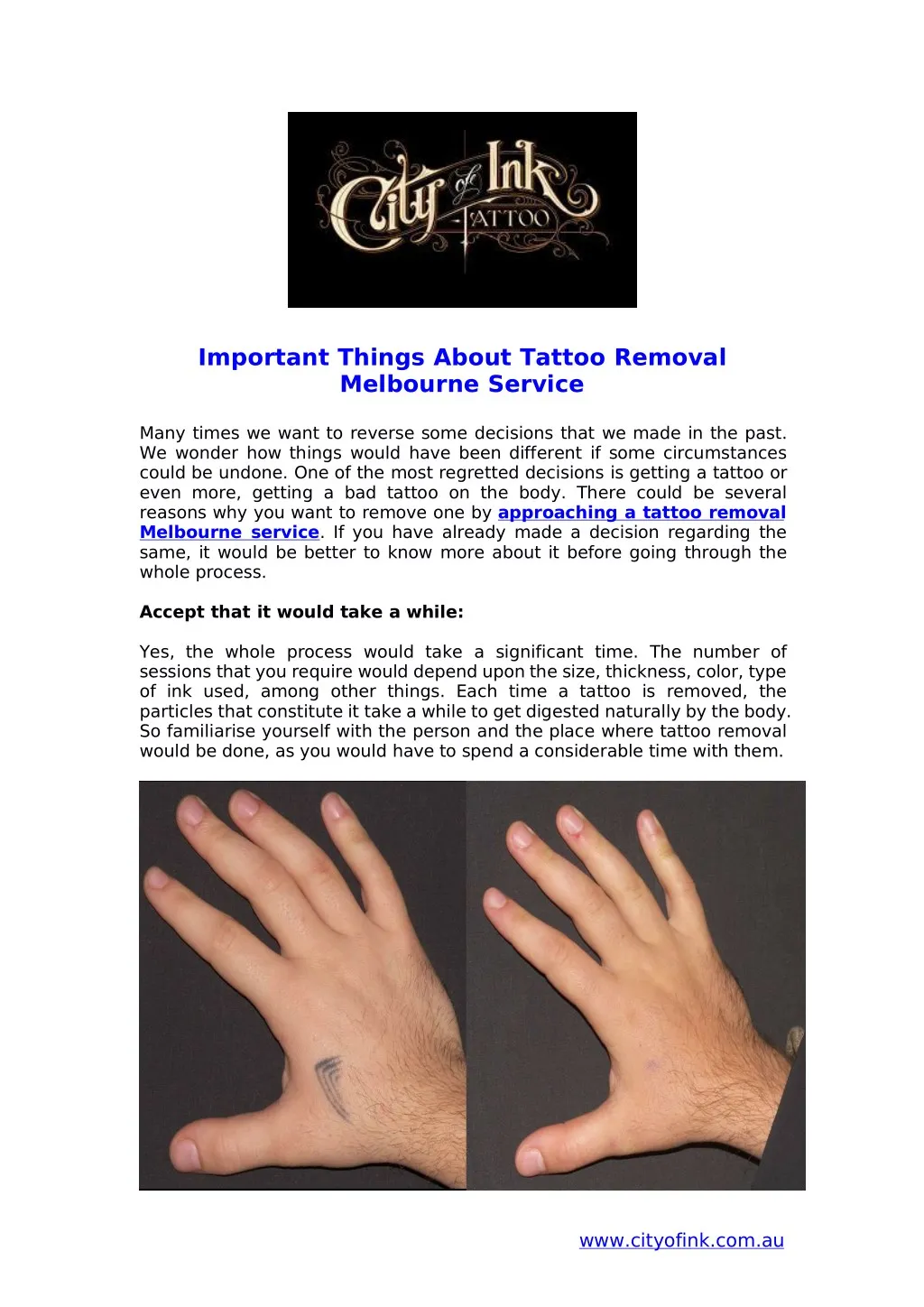 important things about tattoo removal melbourne