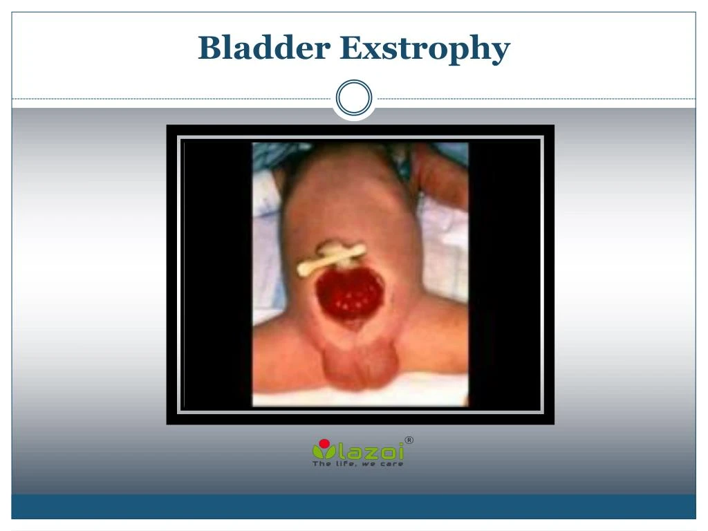 bladder exstrophy