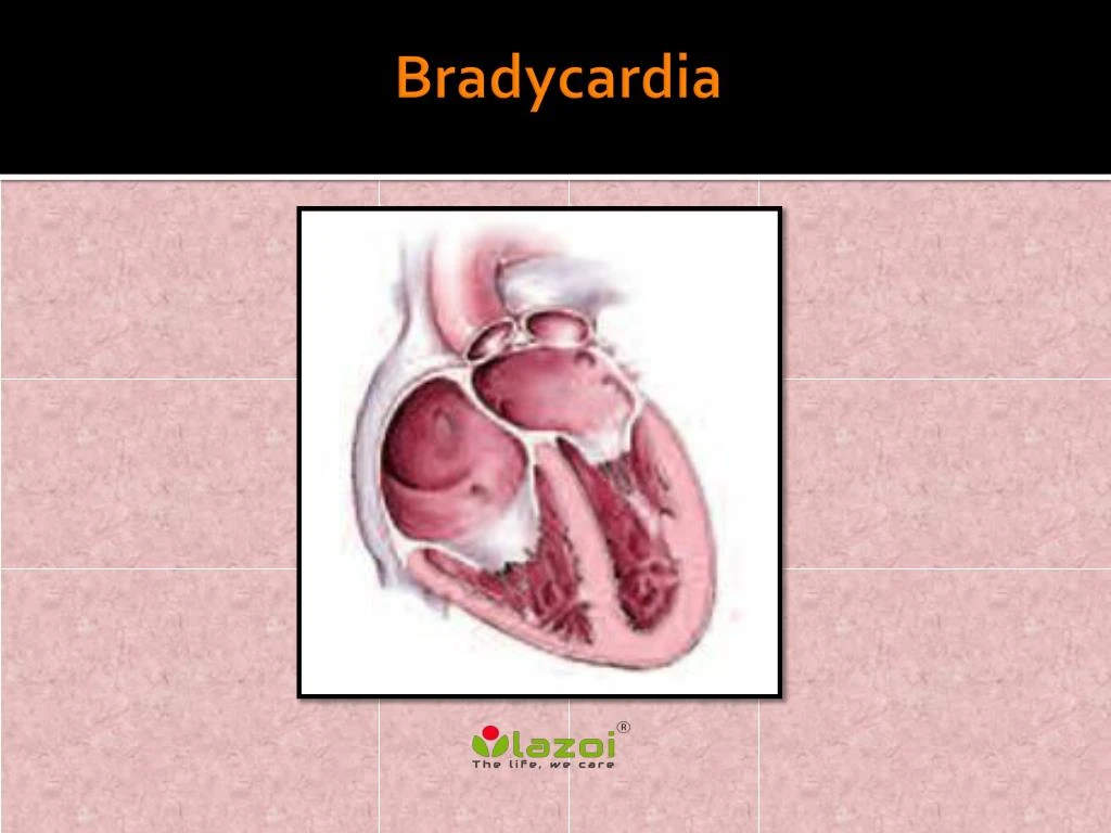 bradycardia