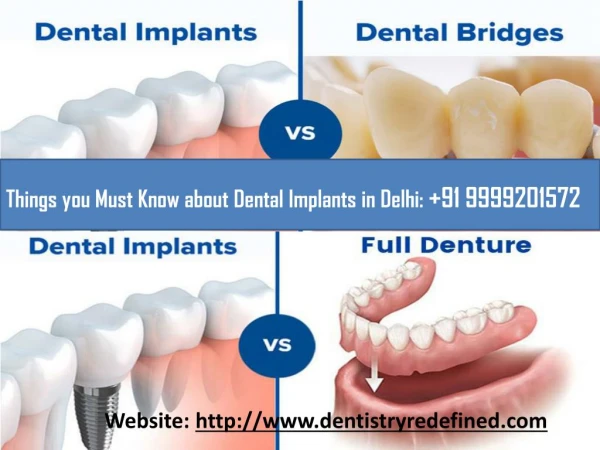Things you must Know about Dental Implants in Delhi