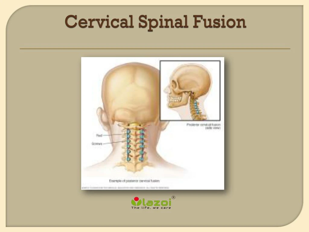 cervical spinal fusion