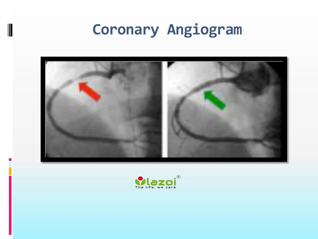 coronary angiogram