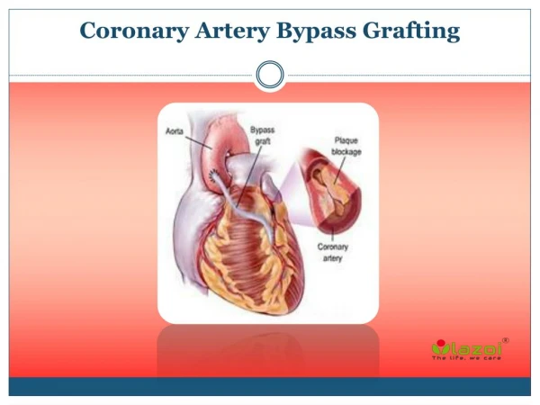 Coronary Artery Bypass Grafting