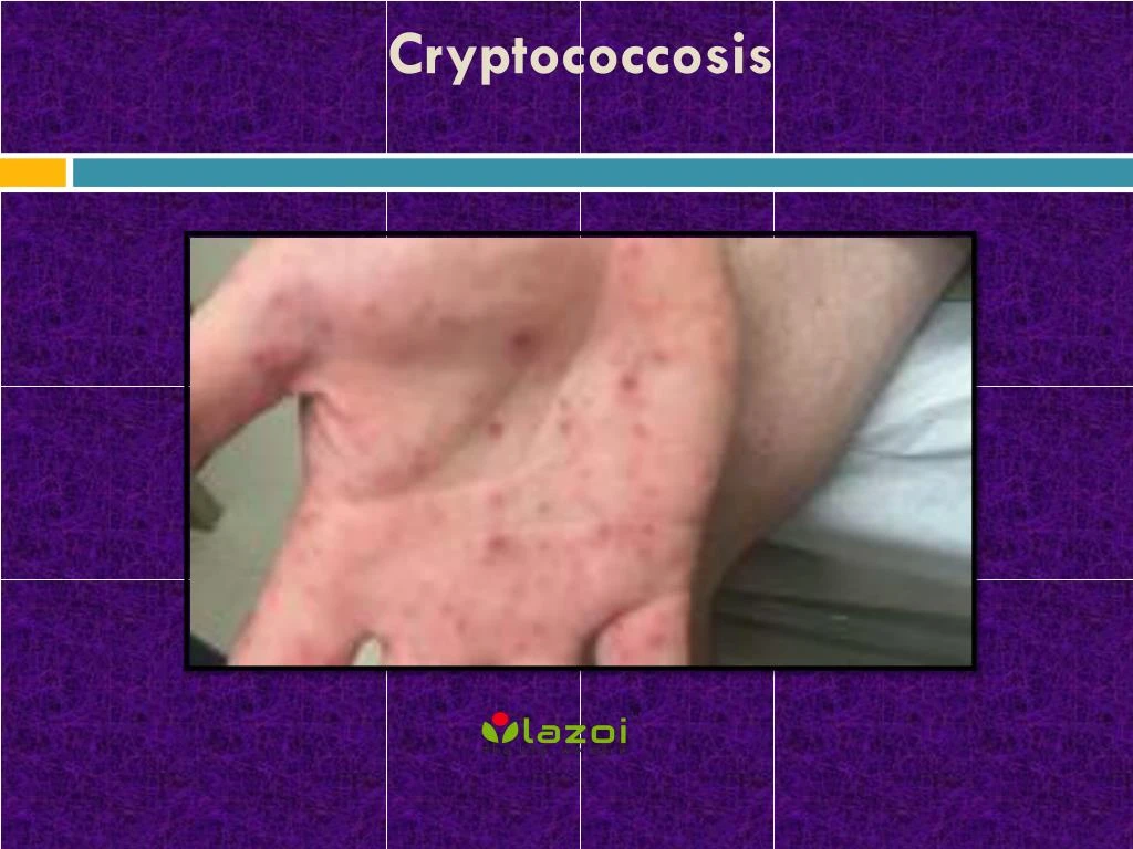 cryptococcosis