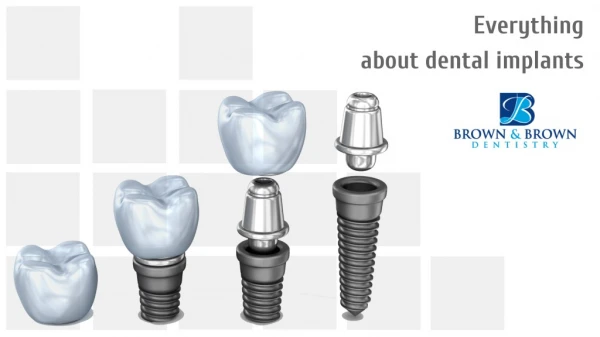 Everything About Dental Implants