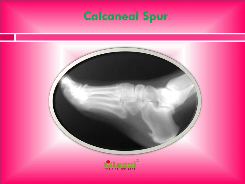 calcaneal spur