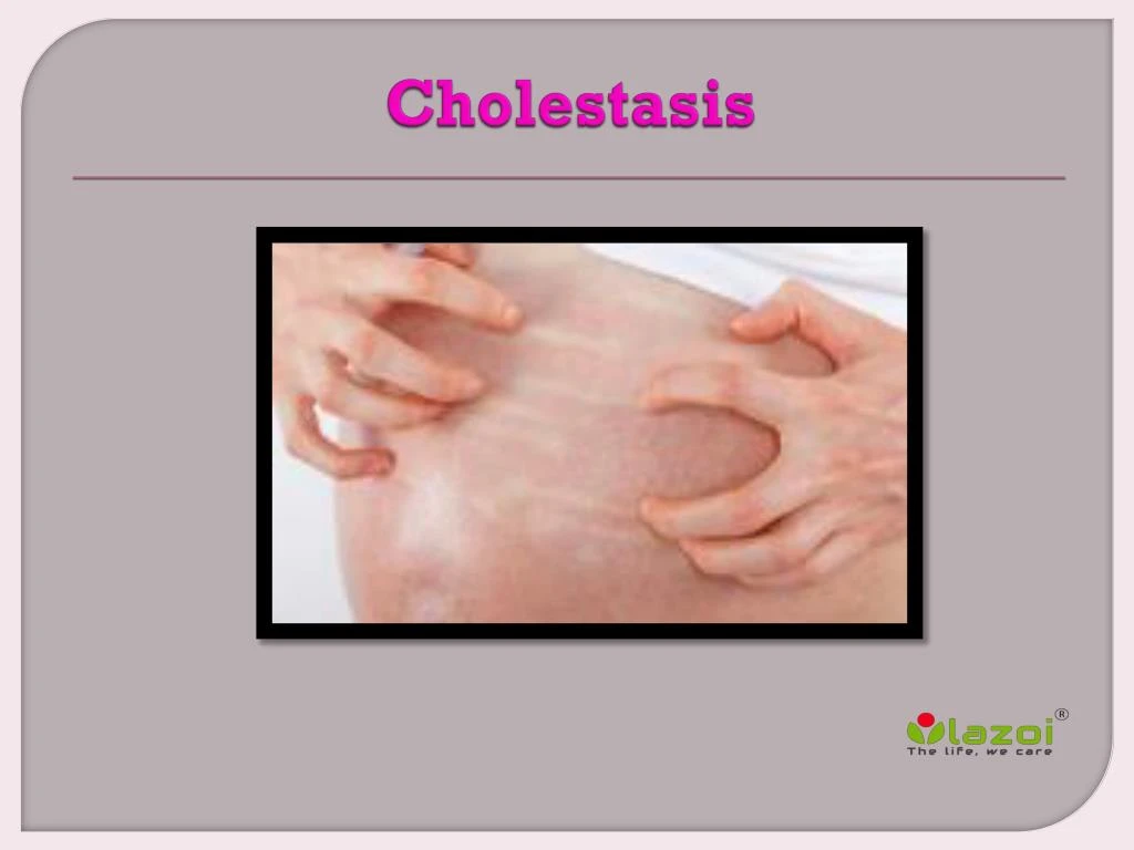 cholestasis