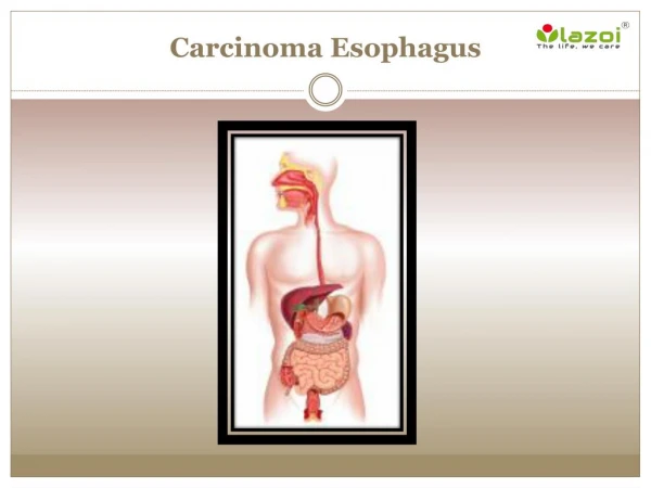 Carcinoma Esophagus