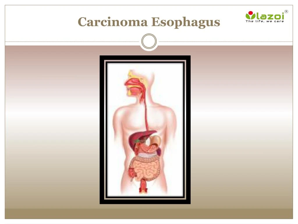 carcinoma esophagus
