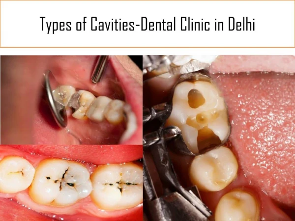 Types of Cavities -Best Dental Clinic in Delhi