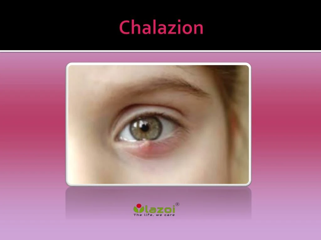 chalazion