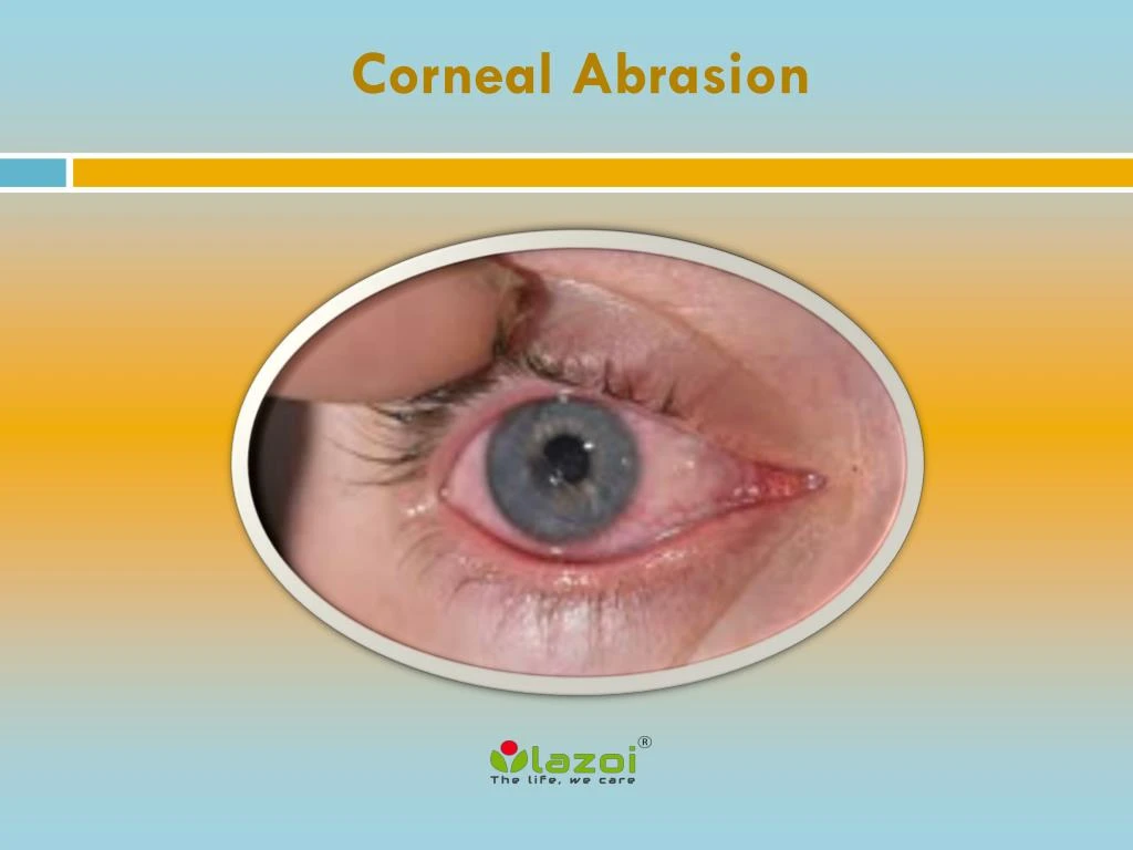 corneal abrasion